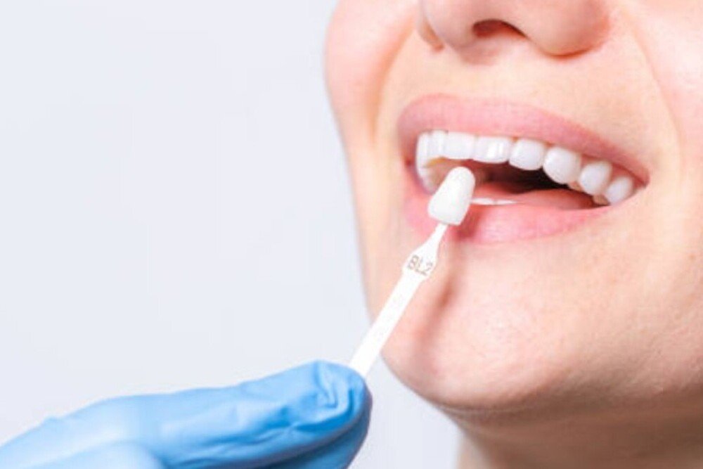 dentista aplicando blanqueamiento dental en clinica tres olivos fuencarral el pardo