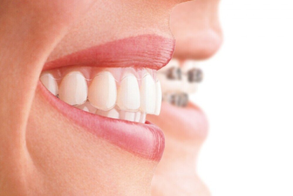 sonrisa con dientes sanos en clinica dental tres olivos tratamiento estetico y limpieza dental